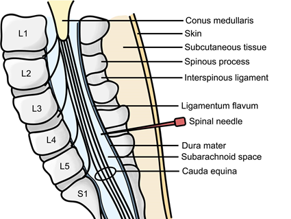 Contraindications for Lumbar Puncture