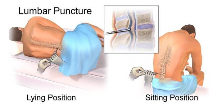 Lumbar Puncture Procedure